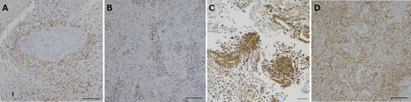 Immunohistochemical analysis for nestin in tumors resected under neoadjuvant bevacizumab (Bev) as compared with that in control glioblastomas.