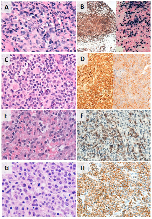 Histopathologic and phenotypic features of selected subtypes of T/NK-PTLD.