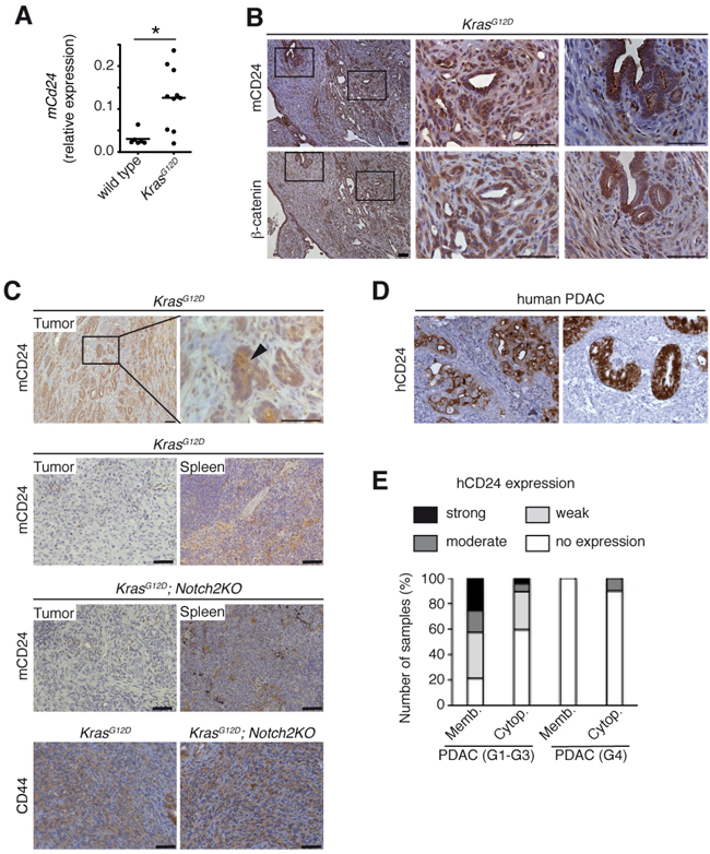 h/mCD24 is expressed in differentiated PDAC.