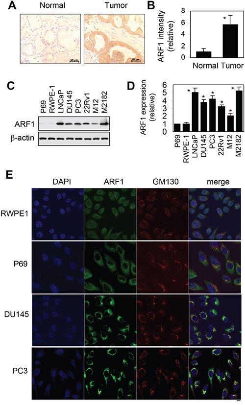 Elevated expression of ARF1 in prostate cancer cells and tumor tissues.