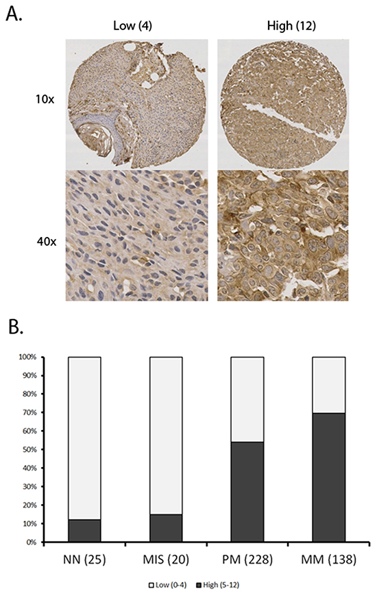 Summary of SERPINA3 staining data in various kinds of melanocytic tumor.