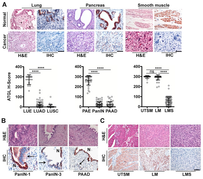 ATGL protein is frequently reduced in human cancer.