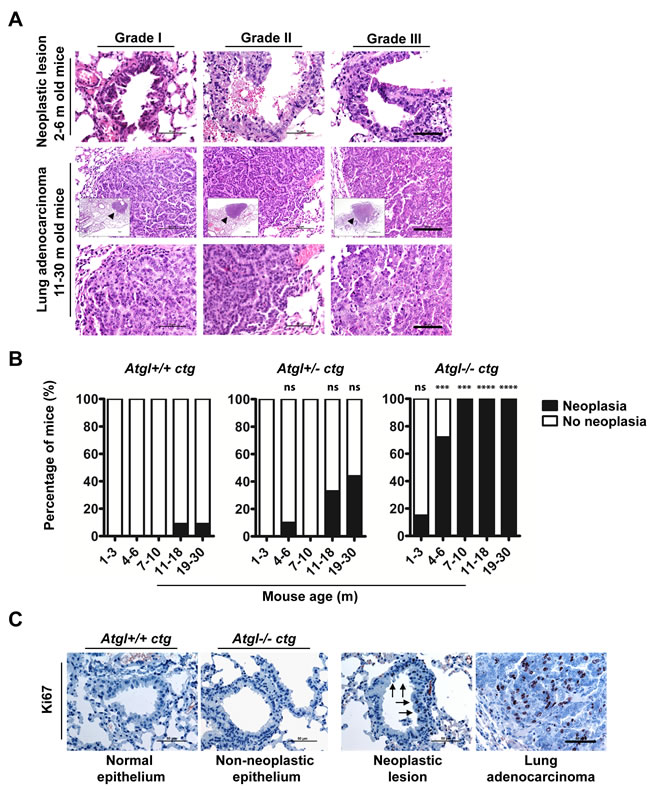 Loss of ATGL results in spontaneous pulmonary neoplasia.