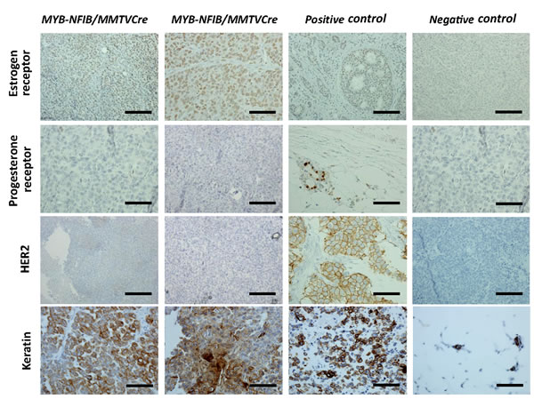 MYB-NFIB/MMTV-Cre/p53+/fl tumors express high levels of ER and keratin.