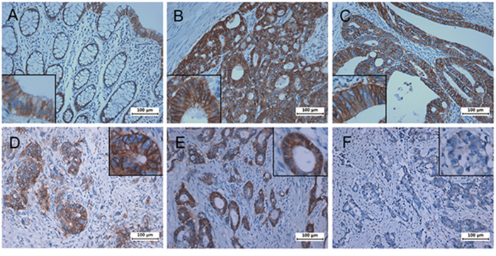 Immunohistochemical analysis of CD46 expression in patient colorectal cancers.