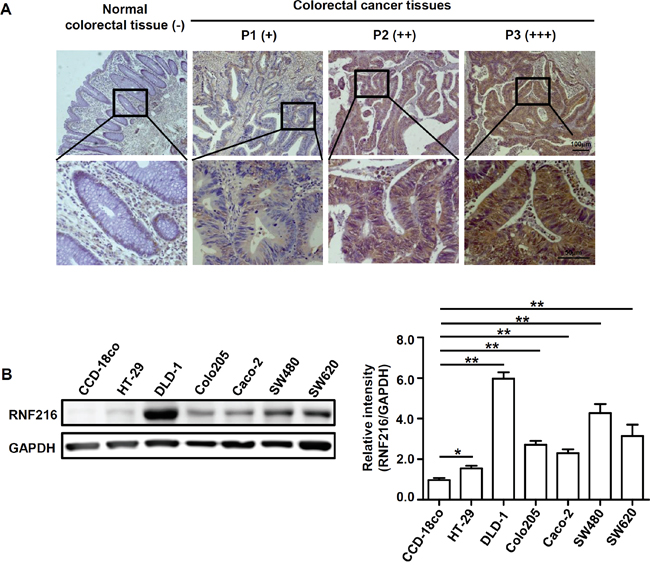 RNF216 expression is upregulated in human CRC tissues and cell lines.