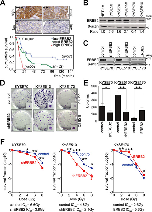 ERBB2 overexpression enhances tumorigenesis and radiation resistance to cause poor prognosis in ESCC.