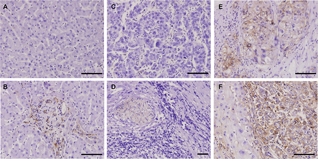 IHC staining of HCC tissues using the H103 scFv Ab.