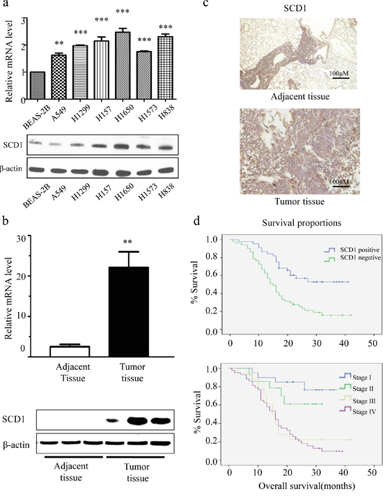 SCD1 is highly expressed in lung adenocarcinoma cells and is associated with patient survival time.