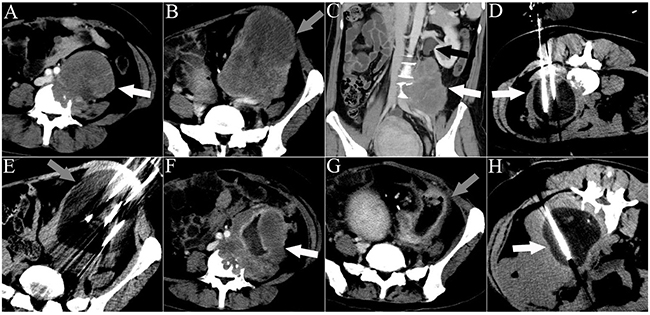CT images of a 33-year-old man who underwent 3 sessions of cryoablation for 2 RPSs.