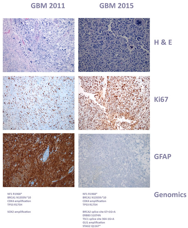 Histology of case 1, glioblastoma progression.