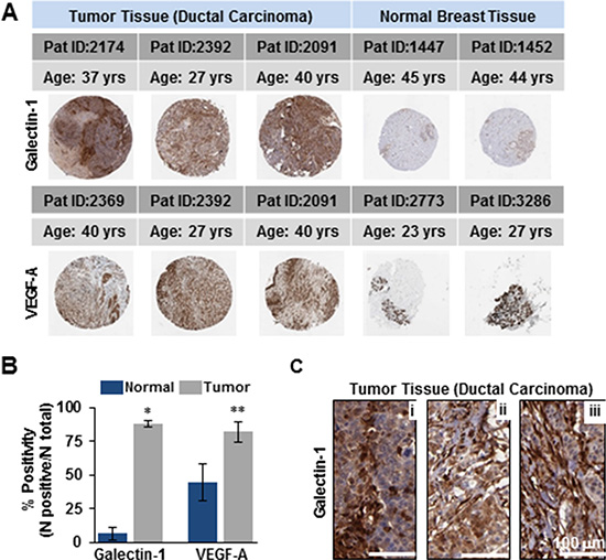 Elevated levels of galectin-1 in human tissues of ductal carcinoma compared to the normal breast tissue resemble the expression profile of VEGF-A.