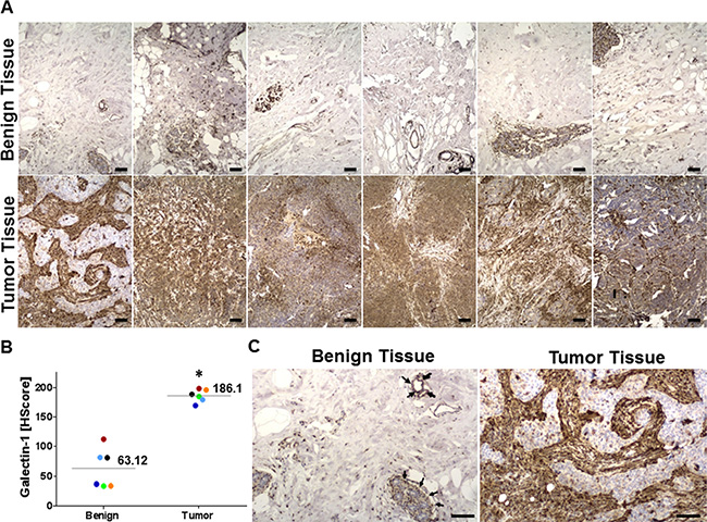 Galectin-1 overexpression in clinical samples of triple negative breast cancer (TNBC) patients.