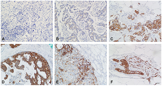 Breast cancer samples show strong differences in TMEM26-specific immunoreactivity.