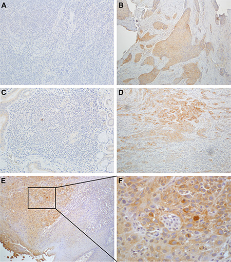 SULF2 IHC staining of HNSCC and healthy control tissues.