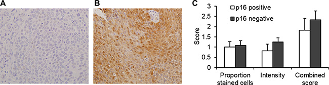 SULF2 expression is not associated with p16 status in HNSCC.