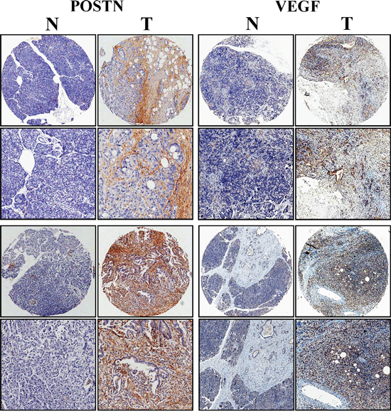 VEGF in pancreatic cancer tissues was significantly correlated with POSTN expression.