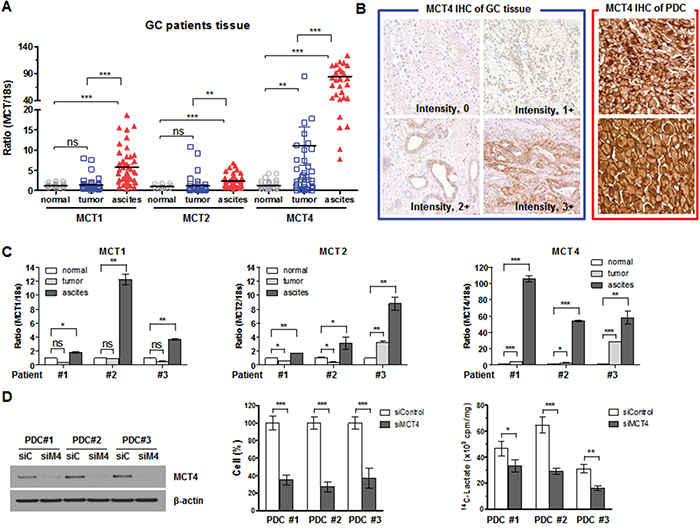 MCTs expression in GC tissues.