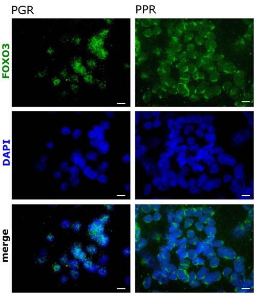 FOXO3 localizes to the cytoplasm in bone marrow cells from prednisone-resistant T-ALL pediatric patients.