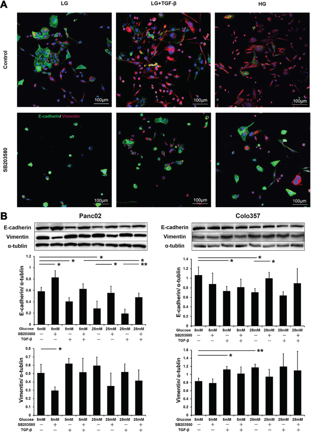 SB203580 inhibits HG-induced tumor cell EMT in vitro.