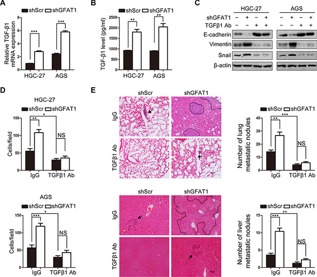 Loss of GFAT1 promotes epithelial-to-mesenchymal transition through inducing TGF-&#x03B2;1 expression in gastric cancer.
