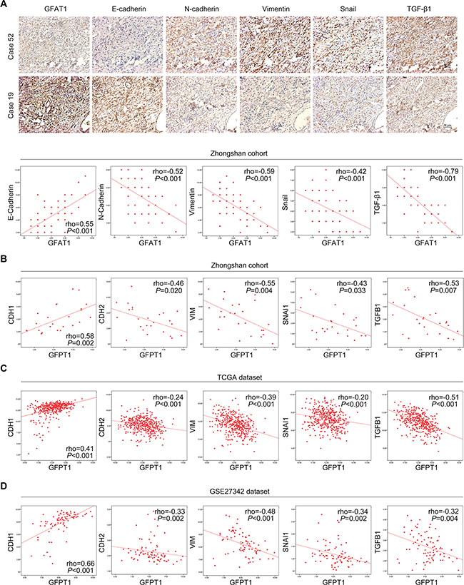 Correlated expression of GFAT1 with EMT-related factors in gastric cancer.