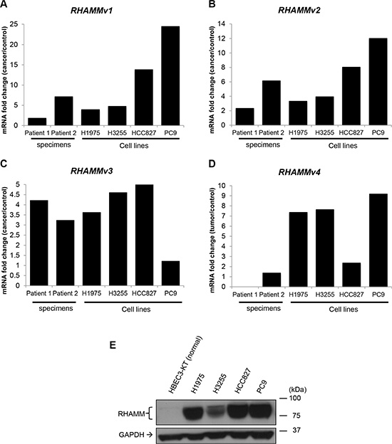 RHAMM variant mRNA and protein expression in human lung adenocarcinoma and cell lines.