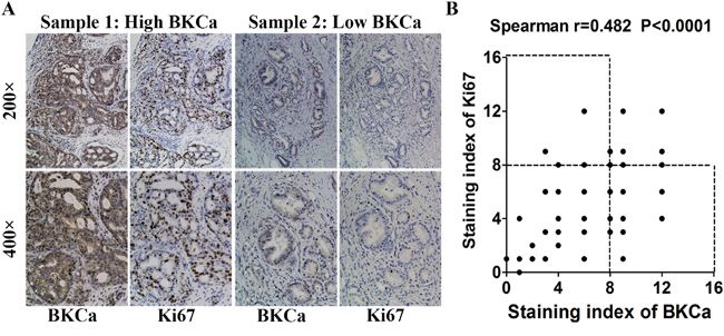 Relationship between BKCa and Ki67 expression in human prostate cancer samples.