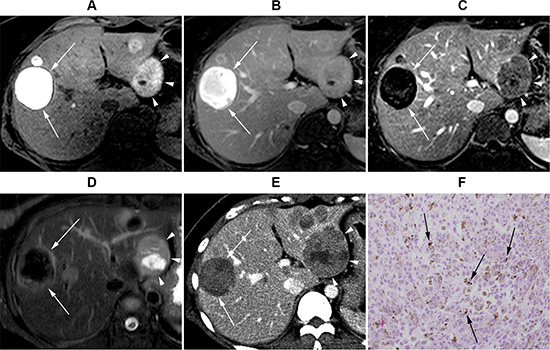 Gadoxeticacid-enhanced liver MRI of a 36-year-old female with uveal melanoma.
