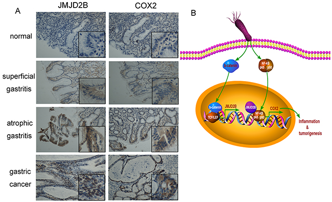 Expression of JMJD2B and COX-2 in human clinical samples from chronic inflammation to gastric cancer.