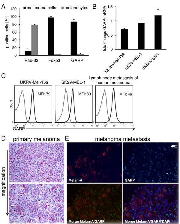 Treg marker expression on human melanoma cell lines and primary melanoma cells in comparison to melanocytes.