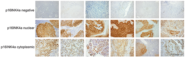 Stratification of oropharyngeal cancer patients according to p16INK4a expression and subcellular localization.