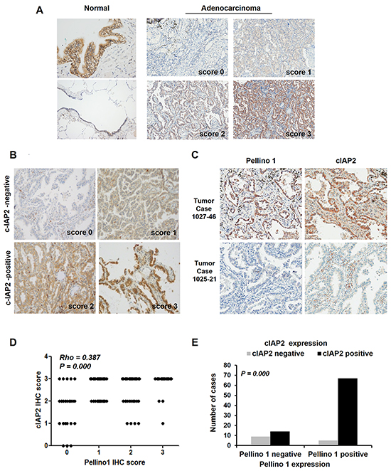Correlation between Pellino-1 and cIAP2 expression in human lung adenocarcinomas.