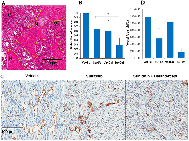 Combination of sunitinib and dalantercept induces tumor necrosis and loss of tumor vasculature.