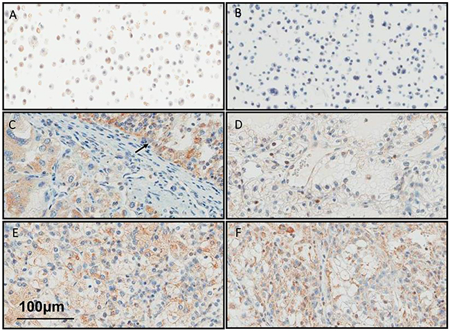 BMP9 is expressed in human RCC.