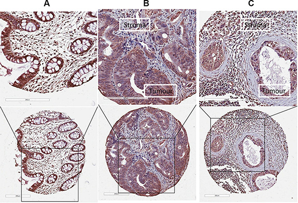 The expression of LOX protein determined by IHC.