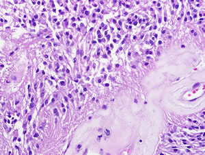 Figure 1D: Spinal cord ependymoma (WHO grade II).