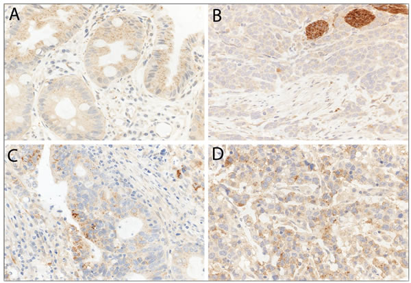 LC3B immunohistochemical staining of Barrett&#x2019;s esophagus (BE) and esophageal adenocarcinoma (EAC).