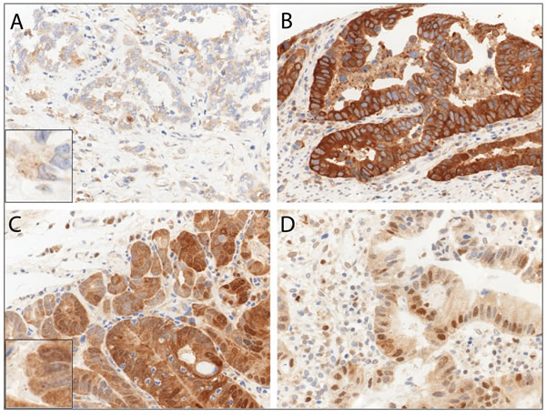Immunohistochemical staining patterns of p62 in esophageal adenocarcinoma (EAC).
