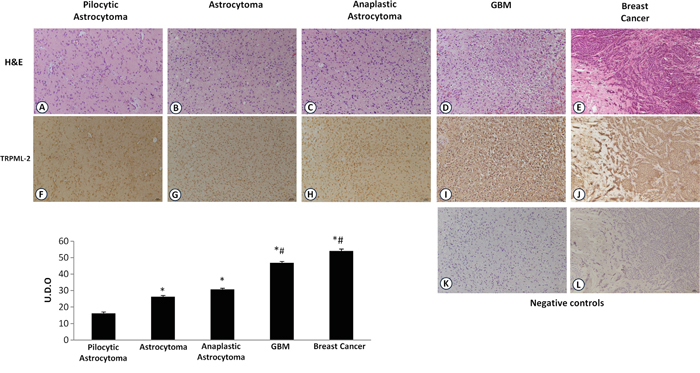 TRPML-2 protein expression in glioma tissues with different pathological grade.