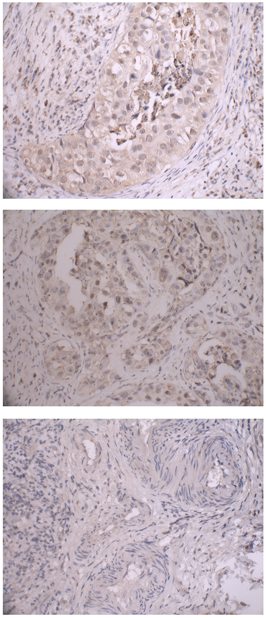 Immunohistochemical staining of TIM-3 protein in breast cancer tissues with rs10053538 GT, TT and GG genotypes.