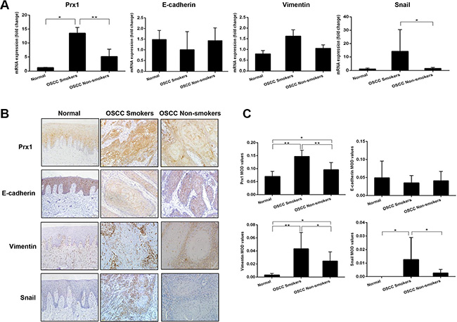 Expression of Prx1 and EMT markers in human OSCC tissues.