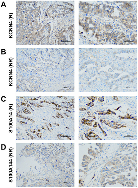 Representative patterns of KCNN4 and S100A14 IHC staining in the SOC cohort.