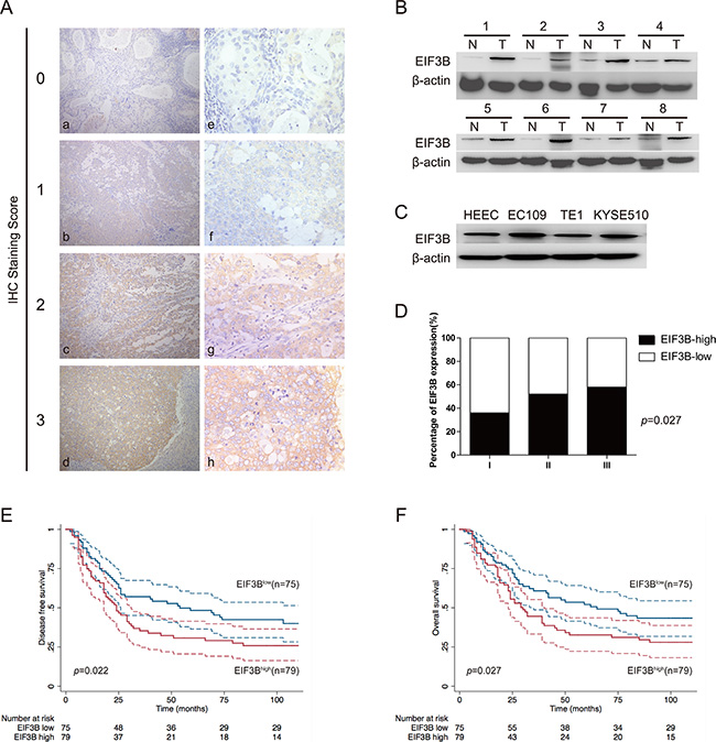 EIF3B expression is overexpressed in ESCC and negatively associated with patents&#x2019; prognosis.