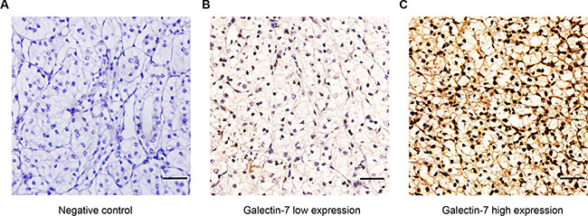 Representative immunohistochemistry staining pictures of ccRCC tissue sections in galectin-7 expression.