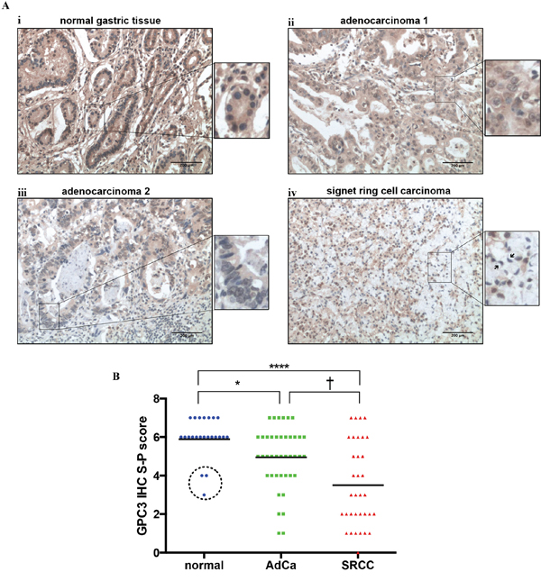 GPC3 protein expression is lower in gastric cancer than in normal gastric tissue.