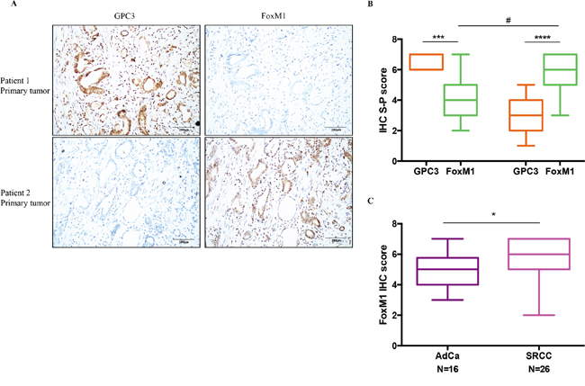 The negative correlation between GPC3 expression and FoxM1 expression in patient tumors.