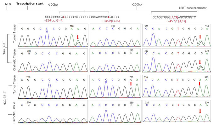 Representative sequence electropherograms of hot spot mutations at -124 and -146 bp and rs2853669 polymorphism at -245 bp from the ATG start site in TERT promoter