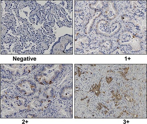 Representative data of GalNAc-T6 immunohistochemical staining (1 : 1000 dilution) in lung adenocarcinoma (&#x00D7; 200).