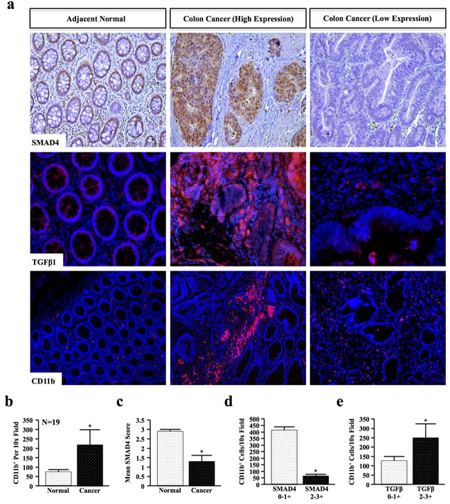 Loss of SMAD4 and TGF&#x3b2; Overexpression Correlate with Increased Myeloid Infiltration in Colon Cancer Patients.
